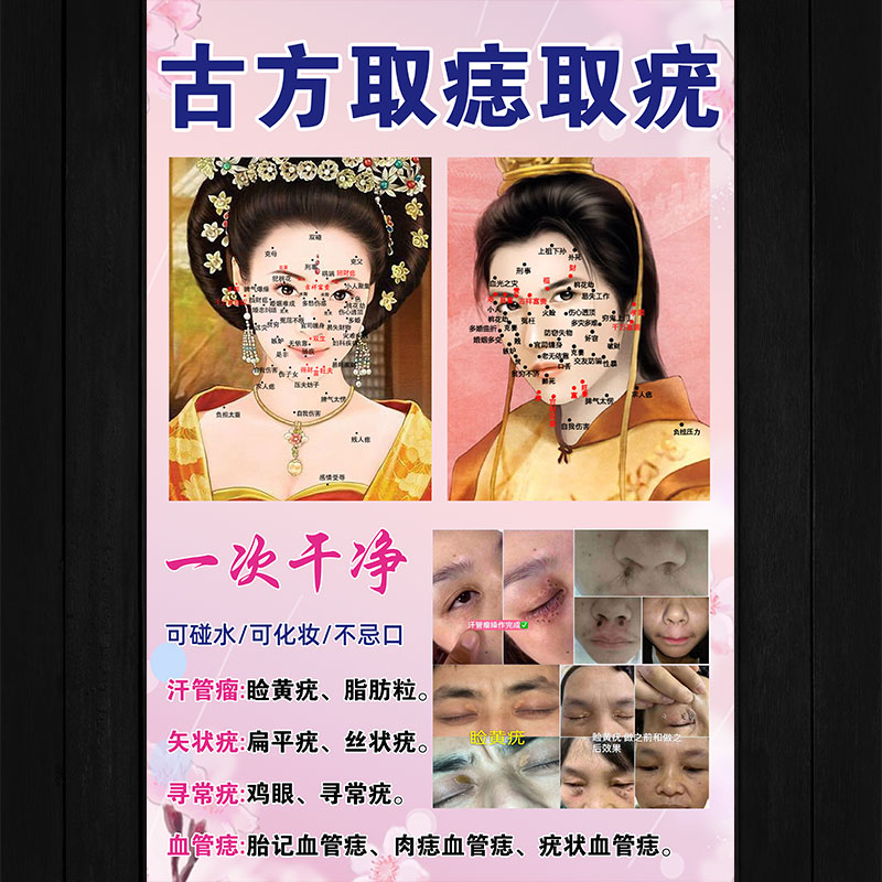 男女面痣图片痣相图解美容院去斑袪痘取疣宣传挂画海报展架易拉宝 - 图2