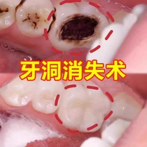 (Anti-Moth-proof) Farewell to tooth decay to prevent tooth decay tooth black Cave with tooth decay to repair the tooth hole black to white ~