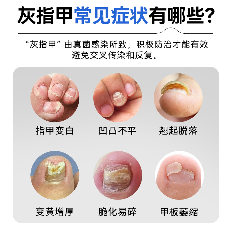洛芙盐酸阿莫罗芬搽剂灰指甲正品旗舰店盐酸阿罗莫芬搽剂灰指甲药