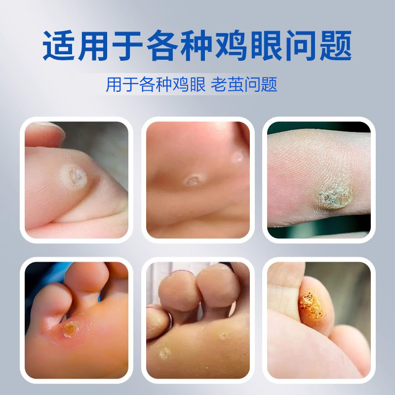 北京同仁堂御医匠鸡眼贴鸡眼膏鸡茧膏鸡贴眼膏去除老茧根脚底zz,淘宝优惠券,粉丝福利购,淘宝优惠卷