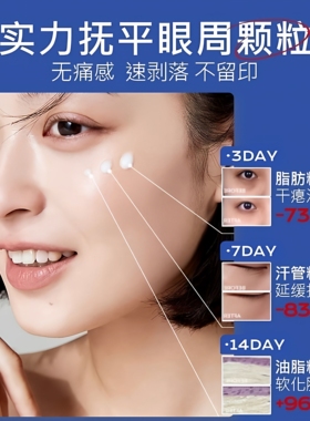 【官方正品眼部脂肪颗粒眼霜】油脂汗管瘤眼周眼角男女士去除神器