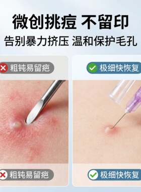 一次性无菌独立装极细粉刺针