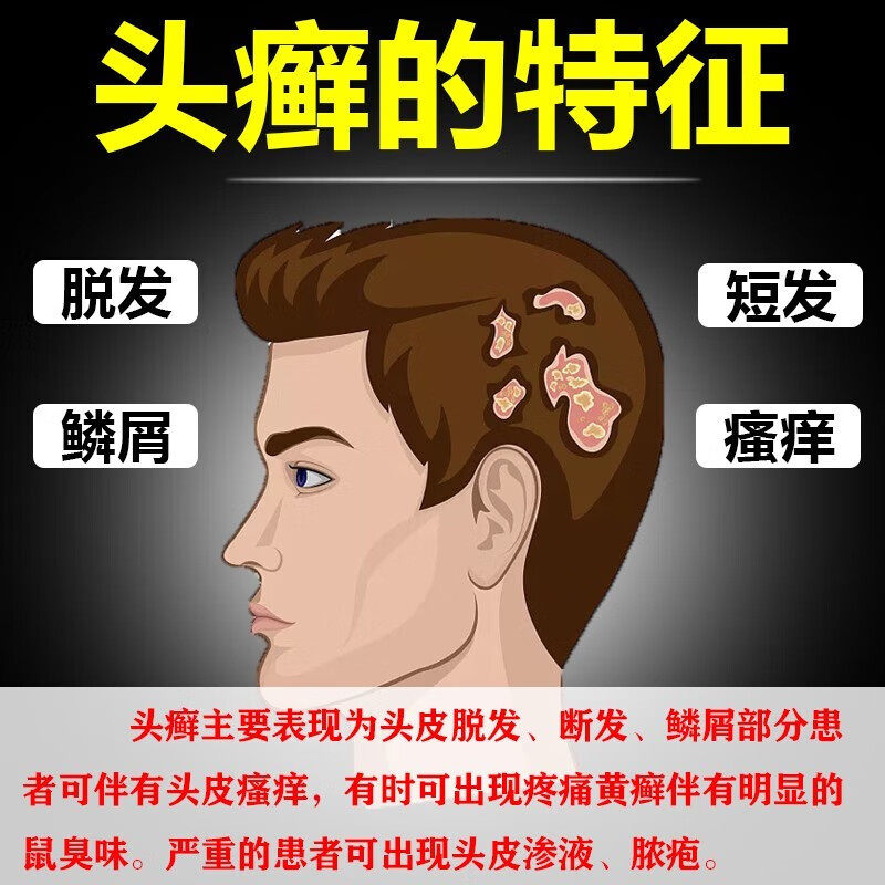 头癣专用药膏头部银屑癣头屑头痒头皮癣毛囊炎特效脂溢性皮炎YQ_虎窝淘