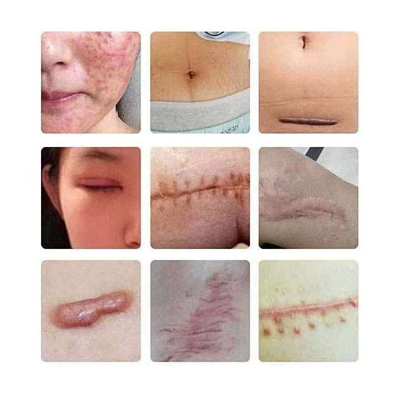 祛疤膏儿童去疤痕贴修复除手术疤儿童烫伤剖腹产专用凝胶医用硅酮