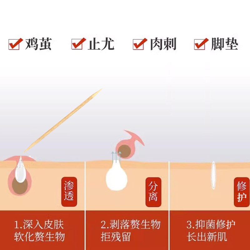跖疣专用膏去除石疣脚底趾疣血胞刺去鸡眼拓尤必净清尤敷料根DF_虎窝淘