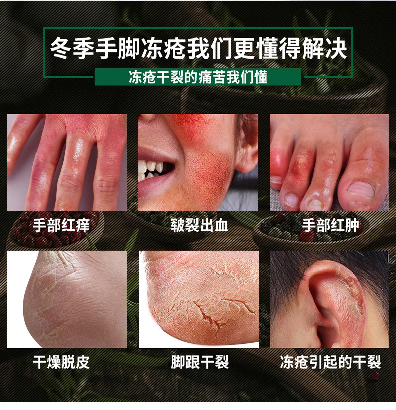 冻疮膏止痒冻伤膏特效药防冻裂消肿儿童宝宝手脚耳朵脸部专用正品-图1