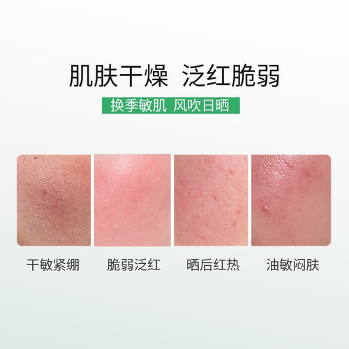 自然攻略依克多因舒敏修护面膜敏感肌改善泛红修护5片/盒 - 图2