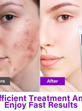 Azelaic Acid 15% gel salicylic acid acne removing cream