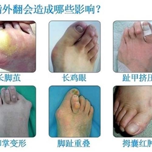 内反趾 新人首单立减十元 21年7月 淘宝海外 内反趾 新人首单立减十元 21年7月 淘宝海外