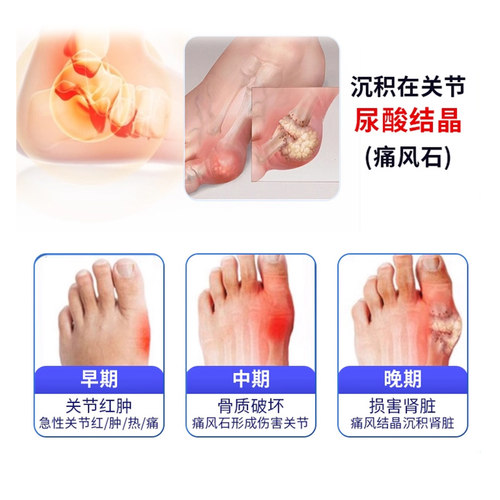 日本进口富士制药多替诺雷降尿酸痛风药降尿酸药正品100片 - 图1