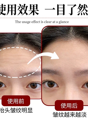 大小眼矫正器训练改善大小眼上眼皮松弛提拉紧致下垂无力提拉贴