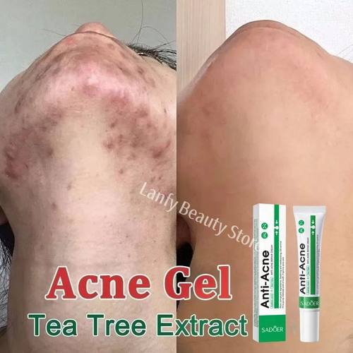 Salicylic Acid Acne atment Face Cream Repair Pimple Spots De - 图0