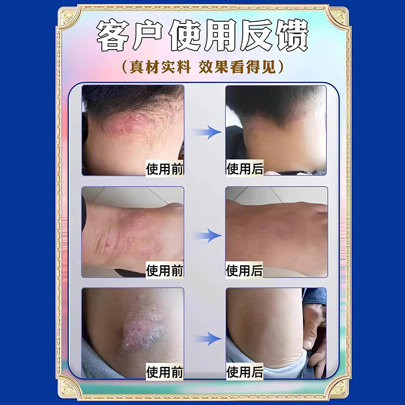 治疗神经性皮炎根去除外用膏顽固皮肤病皮癣藓湿疹真菌感染药膏 - 图1