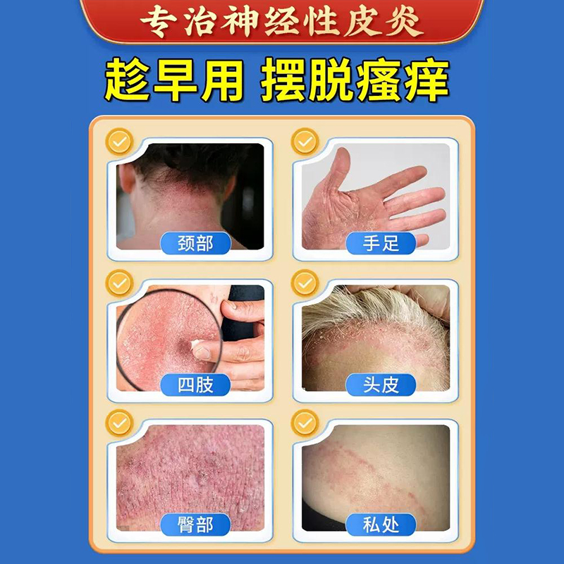 治疗神经性皮炎根去除外用膏顽固皮肤病皮癣藓湿疹真菌感染药膏 - 图0