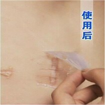 Losala Scar Removal Cream Repair Face Bronzed Scar Patch Surgery Hyperplasia of Rugged Import Gel