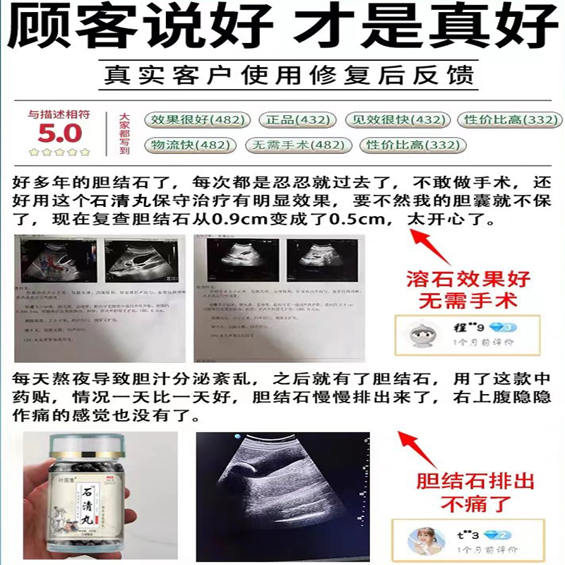 强力消石素德国汉堡胆结石溶石化石清石助消茶胆石化石肾石腰酸颗 - 图3