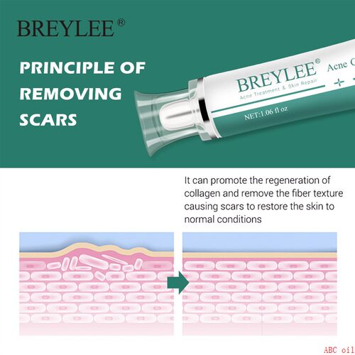 Scar Removal Cream Stretch Marks Removal Acne Skin祛疤膏修护 - 图2