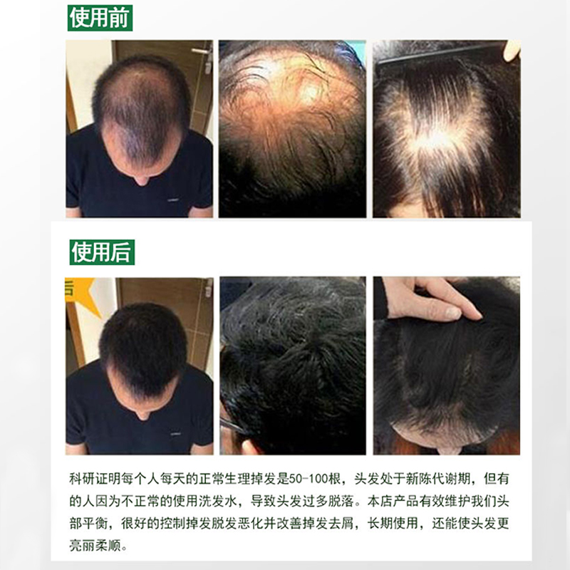 日本jg斑秃30ml/支长生堂生发液 中元海外国际皮肤科药品