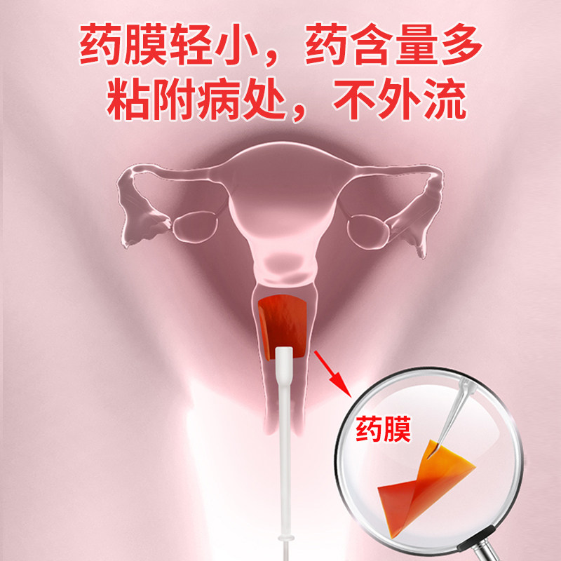 美琛霉菌性阴道炎用药宫颈药 万汉妇科用药