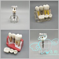 Dental 4 times planting model Planter deplaning display nail baking Porcelain Crown Planting Tooth Repair Contrast 