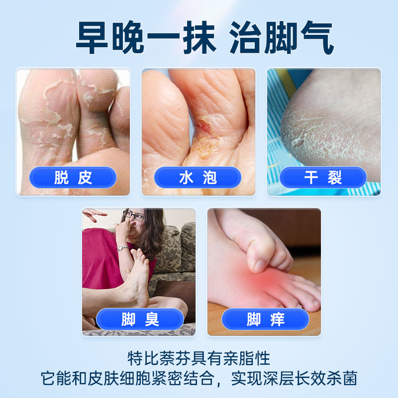 盐酸特比萘芬乳膏去脚气脚痒药治 知原癣症