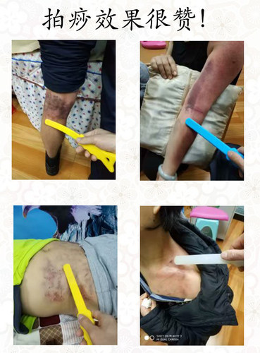 杜氏一指拍痧掌板硅胶按摩捶背经络拍敲打器保健锤棒手养生健康拍 - 图3