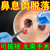 Nasal polyps sinusitis (early and comfortable with early comfy) rhinoceroses rhinocerostomas hypertrophy dredging of nasal polyps with nasal polyps