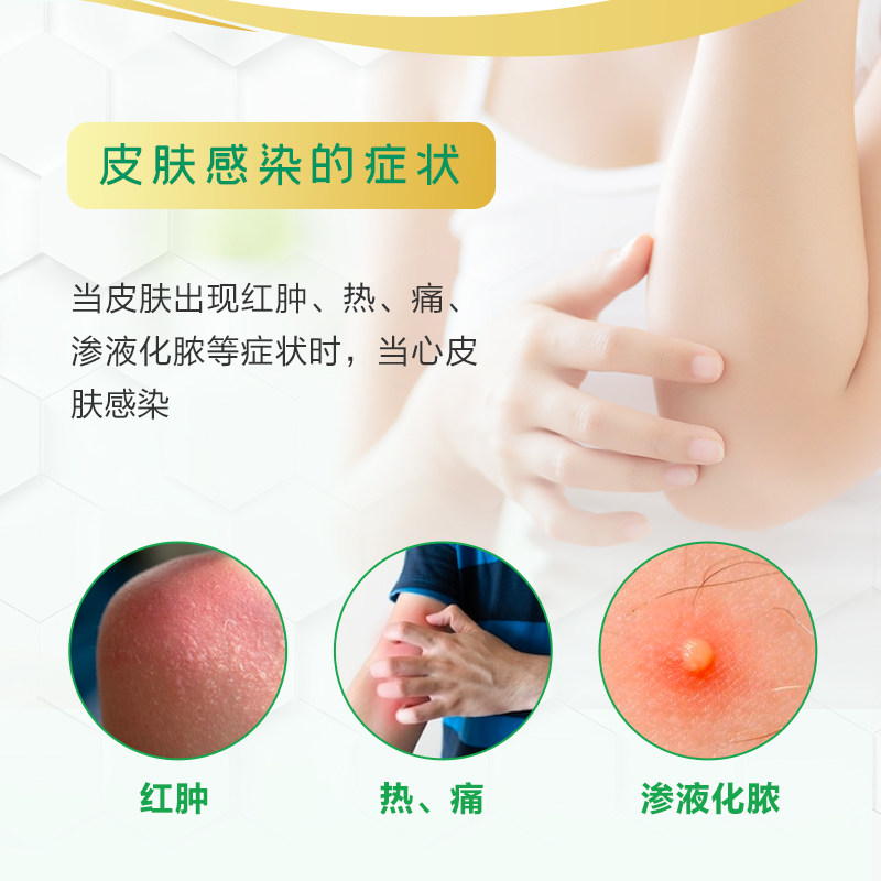 澳美制药澳琪/盒外用莫匹罗星软膏 澳美制药抗菌消炎