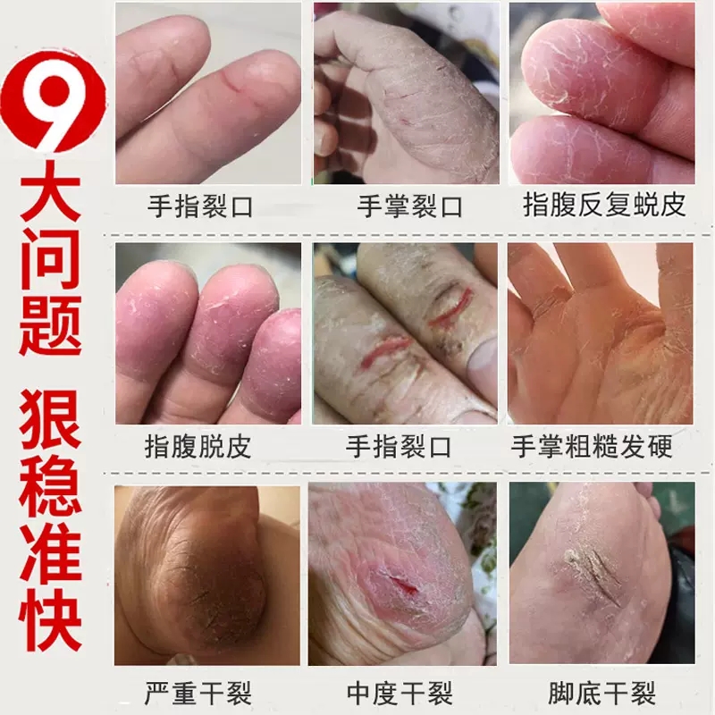 手脚干裂霜防裂护手霜治手裂脚裂膏手指脱皮脚后跟干裂去死皮马油 - 图1