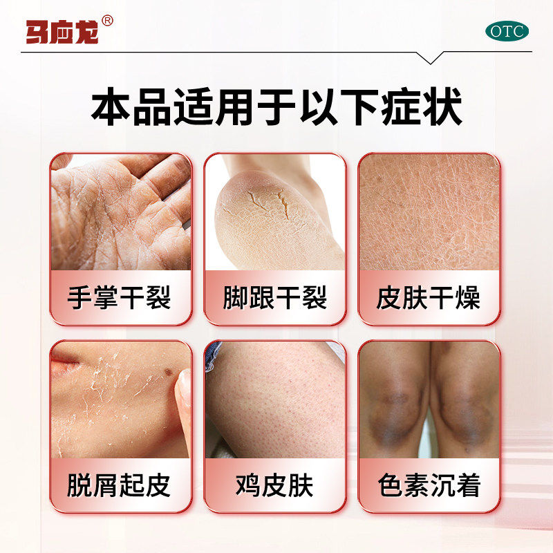 马应龙尿素乳膏10g维生素e乳膏尿素软膏正品皲裂膏脱皮脚后跟干裂,淘宝优惠券,粉丝福利购,淘宝优惠卷