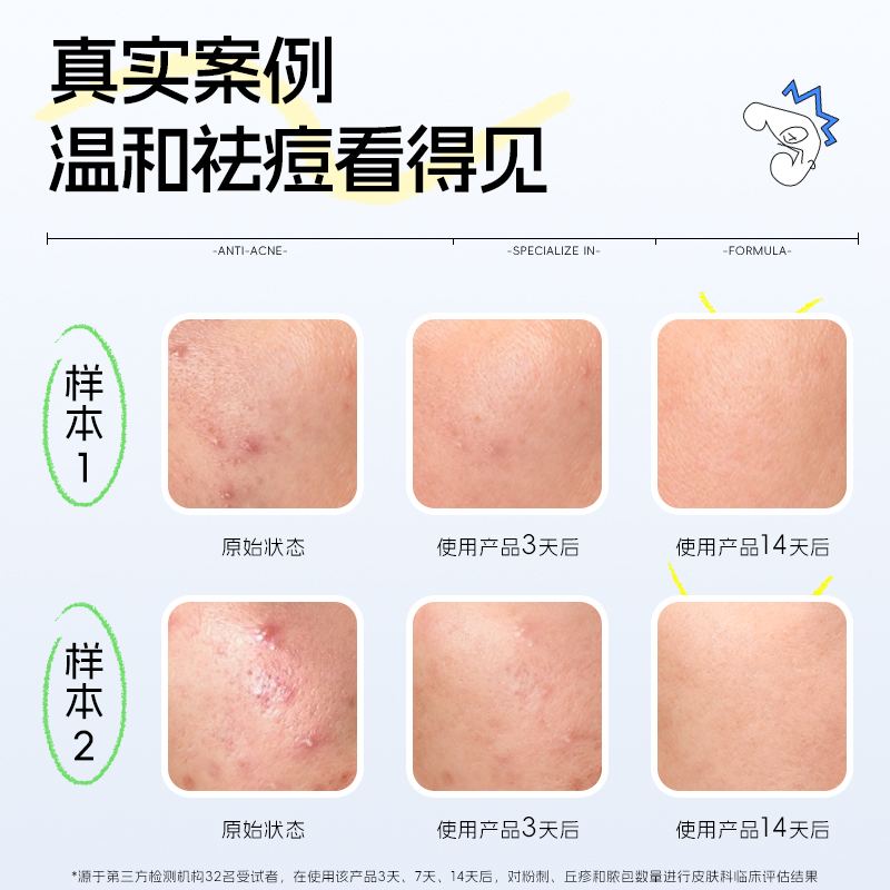 艾芭薇青少年祛痘精华青春期保湿控油舒缓肌肤正品官方旗舰店