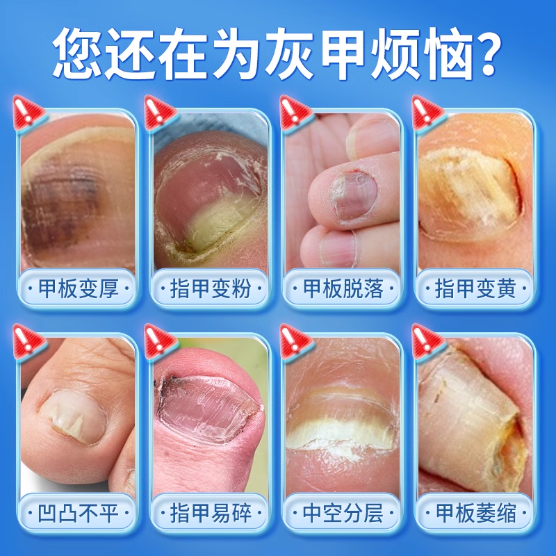 专治疗灰指甲专用药药膏药水正品旗舰店甲癣甲沟炎脚气非特效根BF - 图0