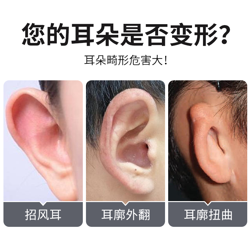 招风耳矫正器收精灵耳贴硅胶耳朵贴定型矫形纠正耳廓改善固定耳贴