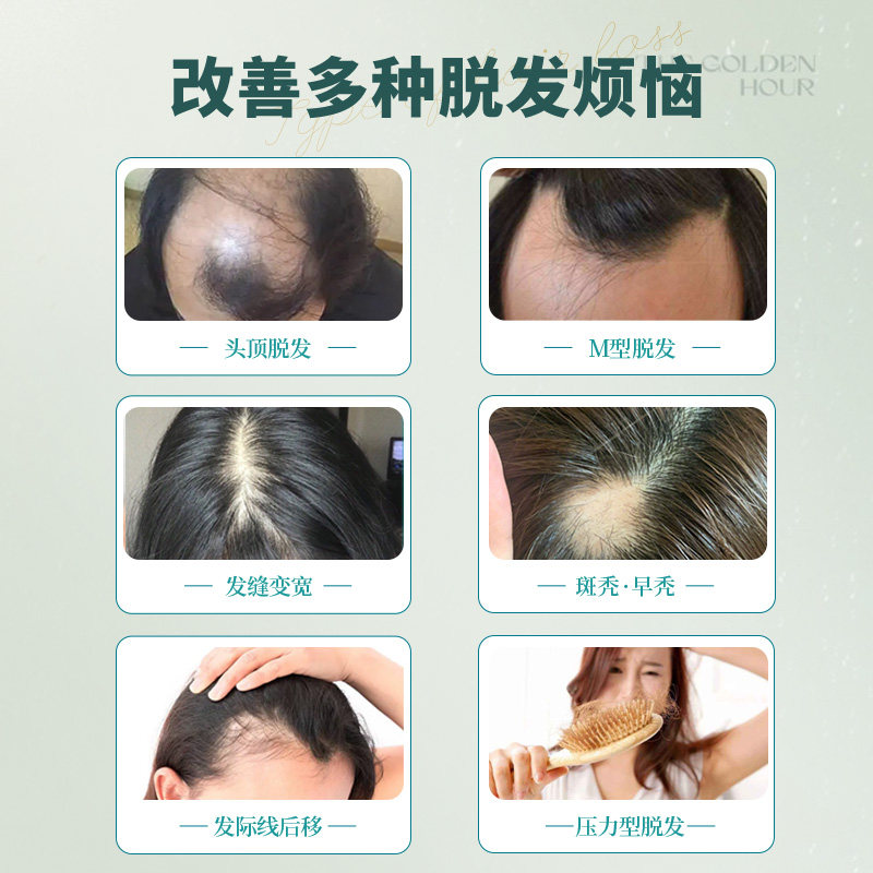 发迹米诺地尔酊正品官方旗舰店增发密发育发男女防脱喷雾生发液_虎窝淘