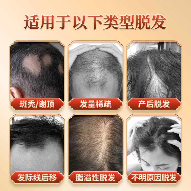 复方斯亚旦生发酊36ml防脱生发液官方旗舰店育发脂溢性脱发润发SY