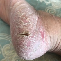 Küchens recommendation = dry and tear of the hands and feet to restore the tender sliding foot heel nourishing and moisturizing the hand cream hand cream