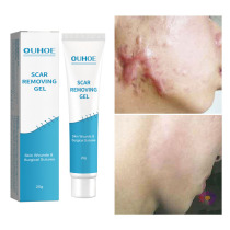 Scars remove cream effecitive fade scars gel removal skin Face