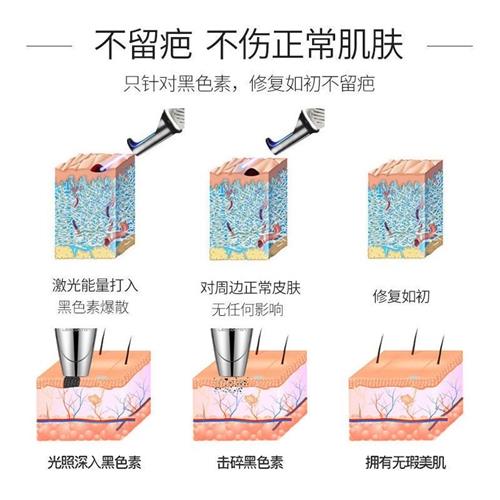 洗纹身激光皮秒祛斑小型仪器洗眉机点痣笔去黑色素痘印神器不留疤-图2