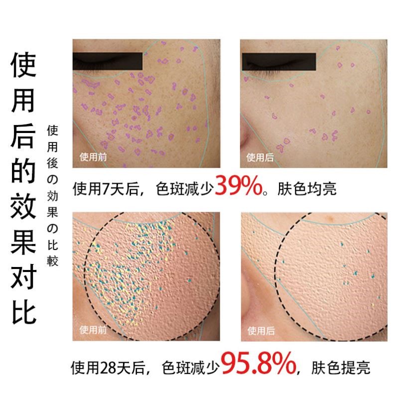 去老人斑专治去老年斑的药膏强力手背部专用药除老年黑班祛斑脸上