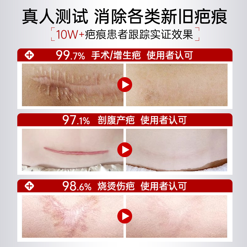 祛疤膏去除疤痕修复烫伤剖腹产手术专用增生凸起医用硅酮凝胶正品 - 图0