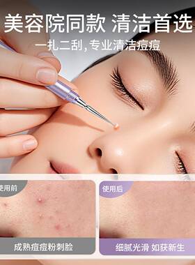 升级扭盖粉刺针超尖细黑头针套装