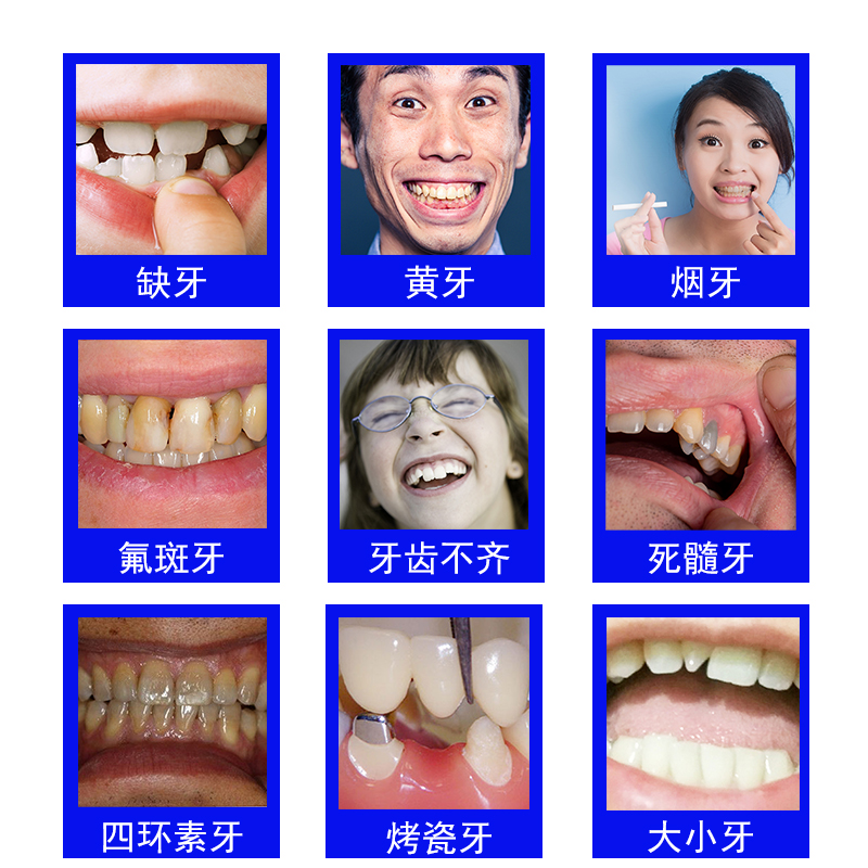 私人订制美白仿真进口牙套美容临时假牙门牙缺失义齿防磨牙定制款-图1