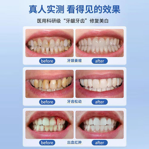 李时珍牙龈萎退缩修复再m生牙膏牙齿牙周口腔炎牙科松动分离剂UU - 图2