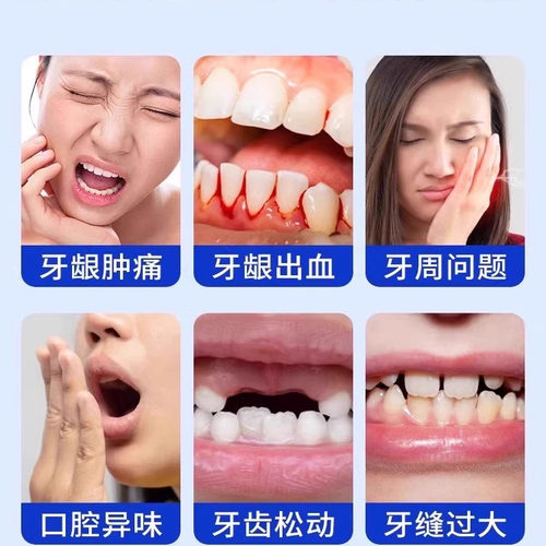 李时珍牙龈萎退缩修复再m生牙膏牙齿牙周口腔炎牙科松动分离剂UU - 图0