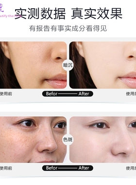 美白祛斑精华安瓶装 面部雀斑黄褐斑妊娠斑老年斑晒斑3g*28支套盒