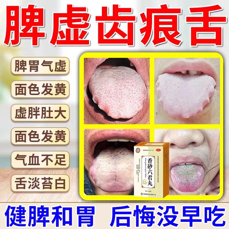 香砂六君丸正品健脾祛湿舌头裂纹齿痕状舌苔黄白厚口臭脾虚湿气重