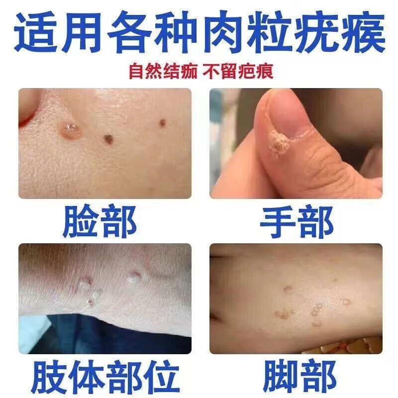 扁平疣祛除软膏去尤瘊脖子上长小肉粒丝状疣一抹灵专用维A酸乳膏
