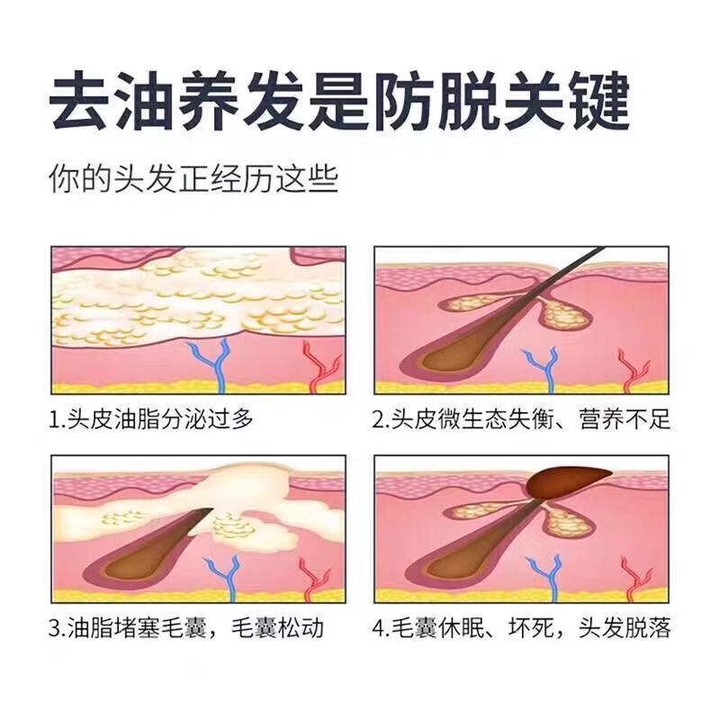 男士脂溢性脱发专用洗发水治疗头皮屑内调生发液大把掉头发kj