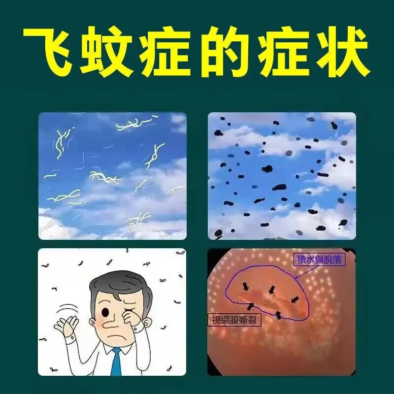 明目地黄丸官方旗舰店眼睛模糊看不清吃什么药飞蚊症眼前黑影飘动