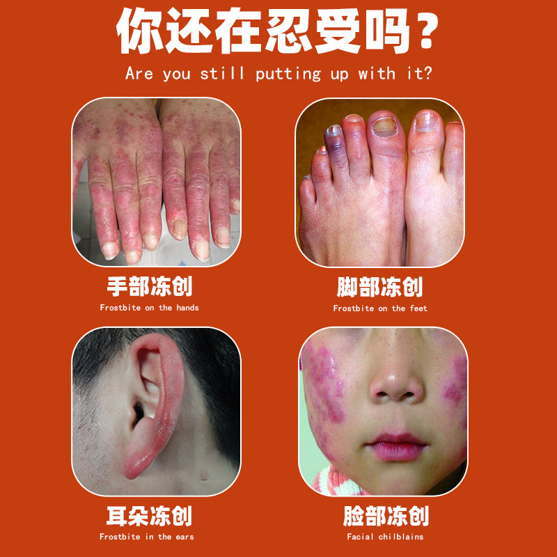 冻疮膏 止痒冻伤膏皲裂膏防裂膏药冻手足儿童耳朵正品官方旗舰店
